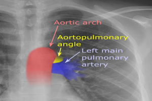 Ein Röntgenbild des Brustbereichs, das den Aortenbogen und den Aortopulmonalwinkel hervorhebt, mit begleitendem Text zur Beschreibung der Herzanatomie.